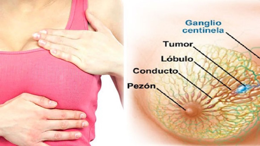 cancer-mama-sintomas-y-causas-esta-enfermedad-n296079-610x343-410741
